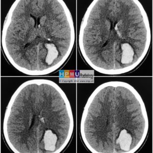 Thông động tĩnh mạch não