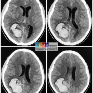 Thông động tĩnh mạch não