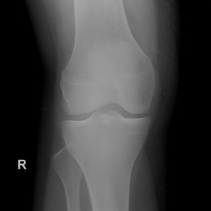 Rách dây chằng chéo sau