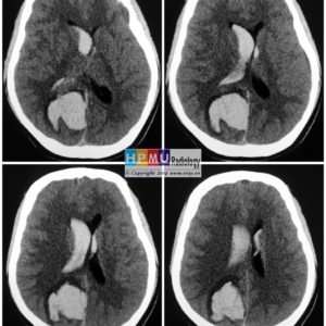 Thông động tĩnh mạch não