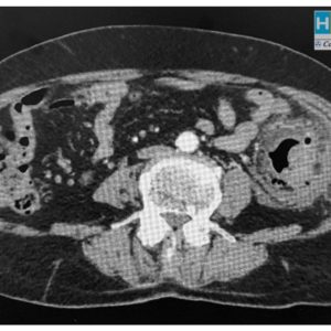 Viêm túi thừa đại tràng