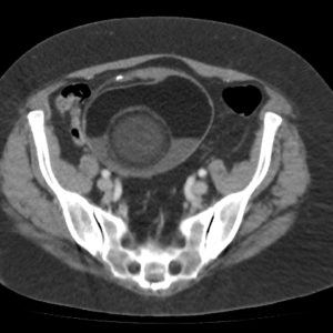 U quái buồng trứng