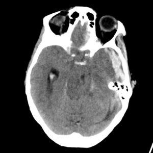 Tụ máu dưới màng cứng