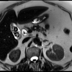 Sỏi đường mật