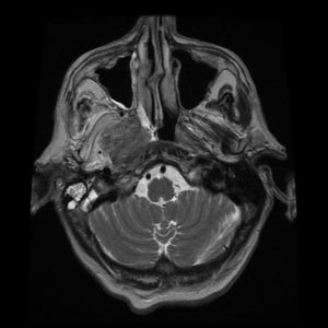 K vòm xâm lấn nội sọ
