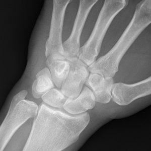 Chấn thương cổ tay