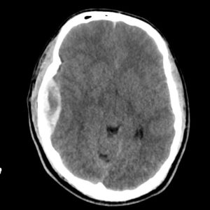 Tụ máu ngoài màng cứng