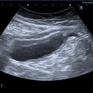 U nhầy ruột thừa