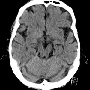 Tụ máu dưới màng cứng