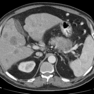 U thân tụy / Di căn gan