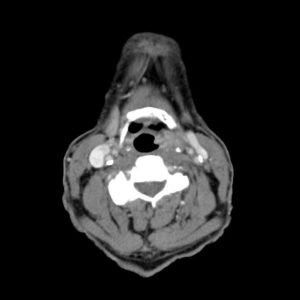 Ung thư thanh quản