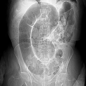 Xoắn đại tràng Sigma