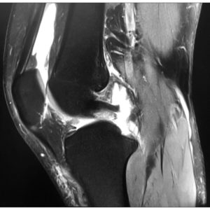 Rách dây chằng chéo