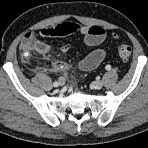 Viêm ruột thừa vỡ