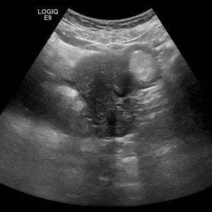 U quái buồng trứng