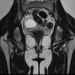 Nang buồng trứng chảy máu