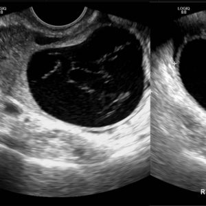 Nang buồng trứng chảy máu