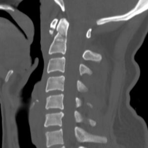 Gãy mỏm nha + Vỡ cung trước C1