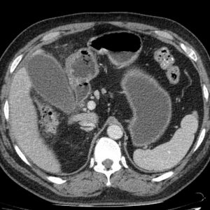 Viêm túi mật cấp