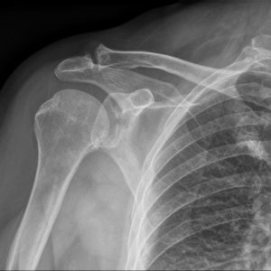 Chấn thương khớp vai