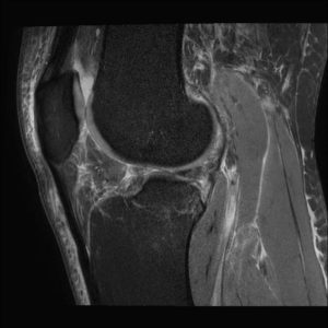 Đứt dây chằng chéo trước