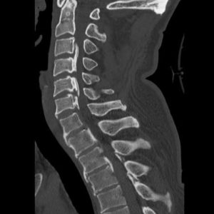Vôi hóa dây chằng dọc sau