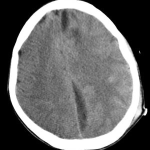 Viêm mủ màng cứng