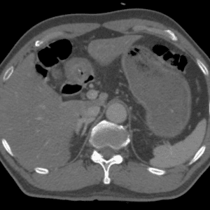 Thủng tạng rỗng