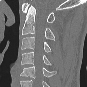 Chấn thương cột sống