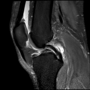 Chấn thương khớp gối