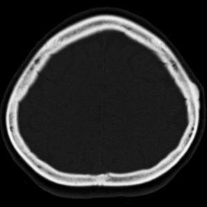U tế bào tạo xương