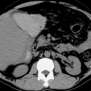 Chấn thương túi mật