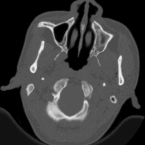 Chấn thương hàm mặt