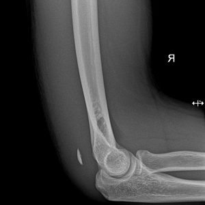 Gãy giật mỏm khuỷu / Đứt gân cơ tam đầu