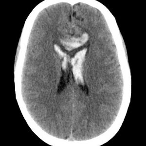 Dị dạng động tĩnh mạch não