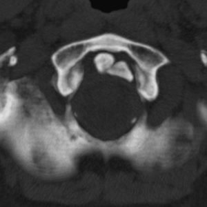 Vôi hóa dây chằng