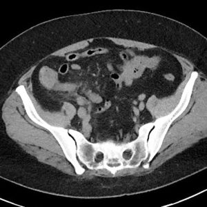 Viêm ruột thừa thủng