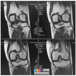 Chấn thương khớp gối