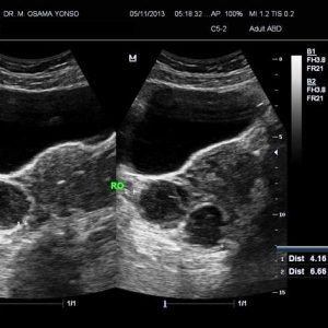 Nang buồng trứng chảy máu