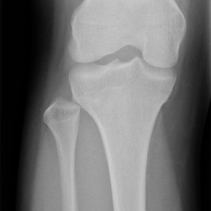 Trật khớp chày mác