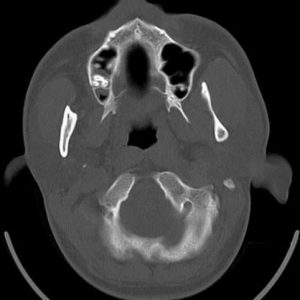 Trật khớp TDH trái