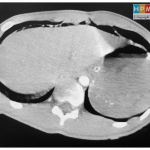 Khí tự do ổ bụng