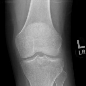 Chấn thương khớp gối