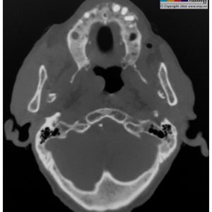 Gãy mỏm lồi cầu + trật khớp TDH 2 bên