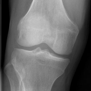 Chấn thương khớp gối