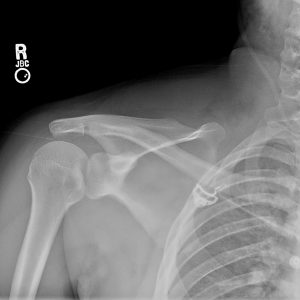 Chấn thương khớp vai