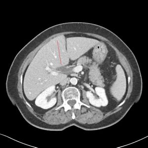 Sỏi đường mật