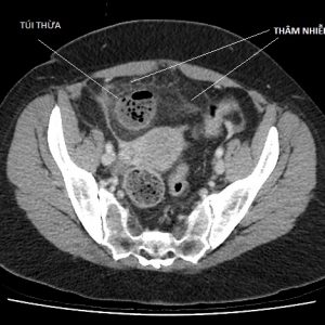 Viêm túi thừa Meckel