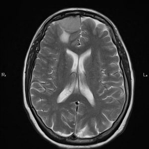 Di căn màng cứng
