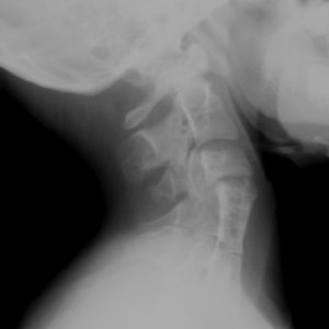 Hội chứng Klippel - Feil